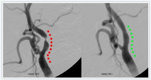 Carotid Pre Post