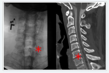 Myleogram Spine